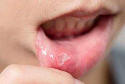 Chữa nhiệt miệng hiệu quả ngay tại nhà bằng mật ong